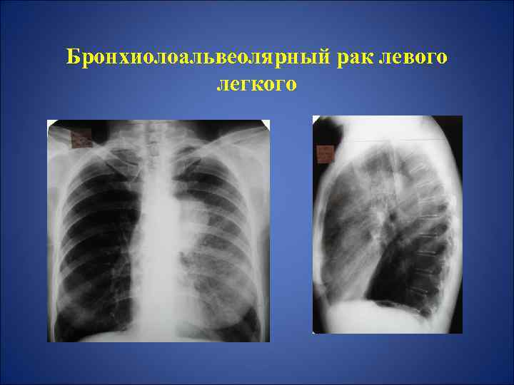 Бронхоальвеолярный рак презентация