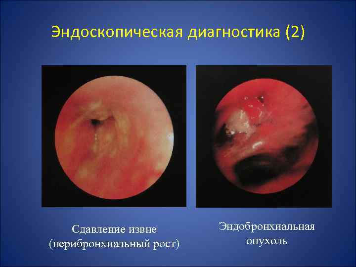 Эндоскопическая диагностика (2) Сдавление извне (перибронхиальный рост) Эндобронхиальная опухоль 