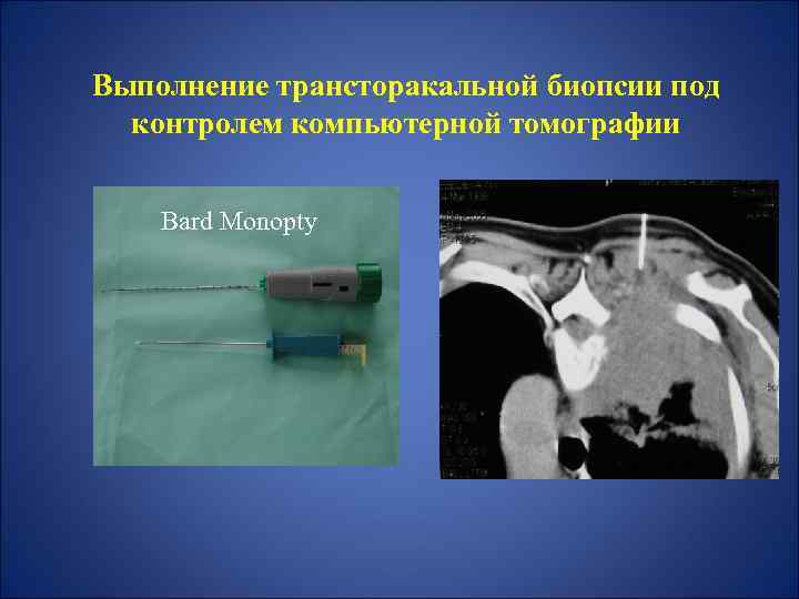 Выполнение трансторакальной биопсии под контролем компьютерной томографии Bard Monopty 