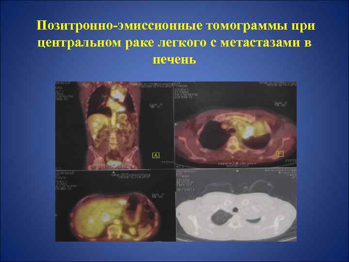 Позитронно-эмиссионные томограммы при центральном раке легкого с метастазами в печень 