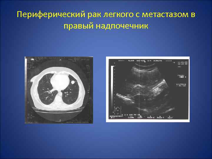Периферический рак легкого с метастазом в правый надпочечник 