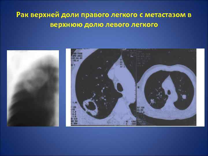 Рак верхней доли правого легкого с метастазом в верхнюю долю левого легкого 