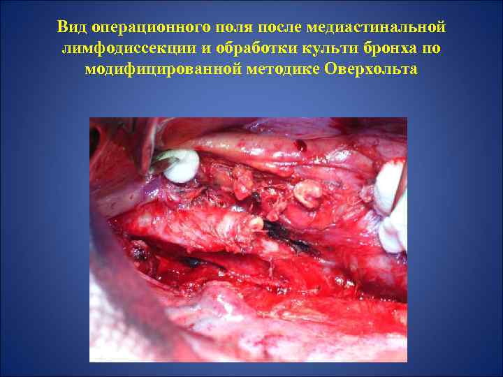 Вид операционного поля после медиастинальной лимфодиссекции и обработки культи бронха по модифицированной методике Оверхольта