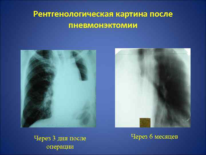 Рентгенологическая картина после пневмонэктомии Через 3 дня после операции Через 6 месяцев 