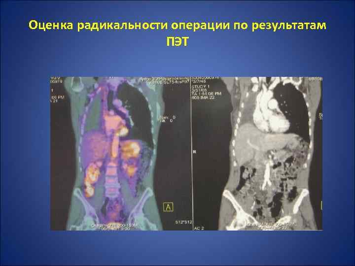 Оценка радикальности операции по результатам ПЭТ 