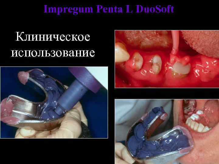 Impregum Penta L Duo. Soft Клиническое использование 