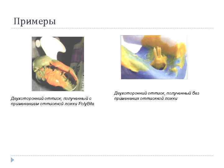 Примеры Двухсторонний оттиск, полученный с применением оттискной ложки Poly. Bite Двухсторонний оттиск, полученный без