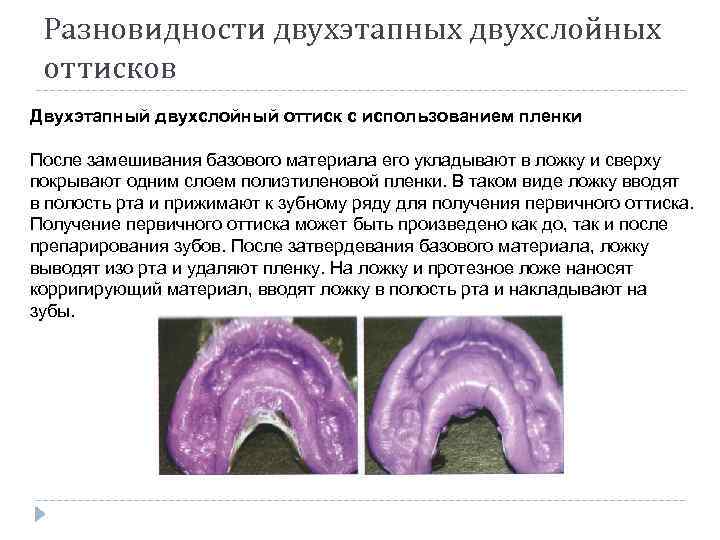 Снятие оттиска индивидуальной ложкой под псп