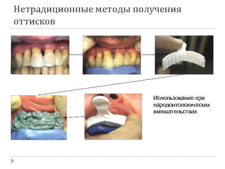 Нетрадиционные методы получения оттисков Использование при пародонтологических вмешательствах 