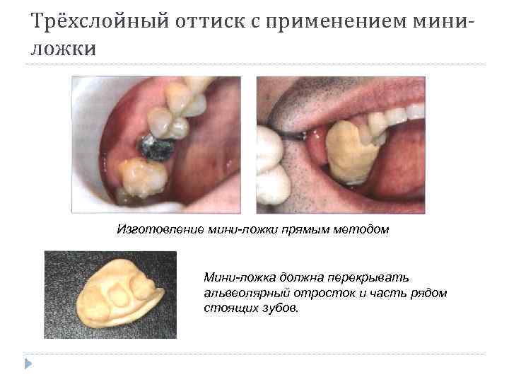 Трёхслойный оттиск с применением миниложки Изготовление мини-ложки прямым методом Мини-ложка должна перекрывать альвеолярный отросток