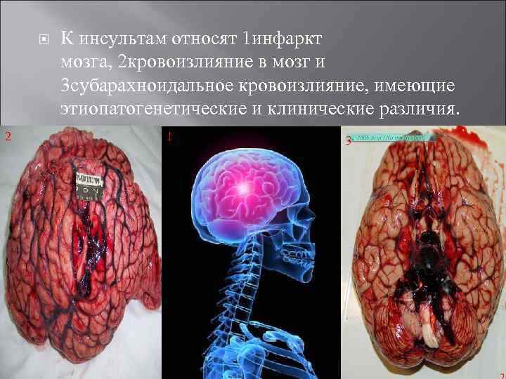  2 К инсультам относят 1 инфаркт мозга, 2 кровоизлияние в мозг и 3