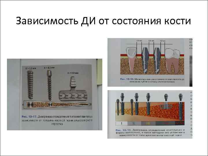 Зависимость ДИ от состояния кости 