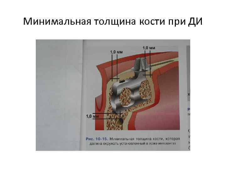 Минимальная толщина кости при ДИ 