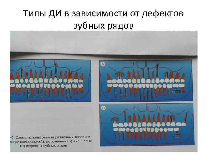 Дефекты зубных рядов. Двусторонний концевой дефект зубного ряда. Виды дефектов зубных рядов. Включенные и концевые дефекты зубных рядов. Классификация дефектов полости рта.