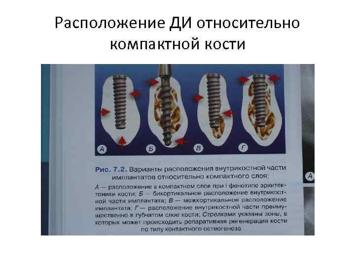 Расположение ДИ относительно компактной кости 