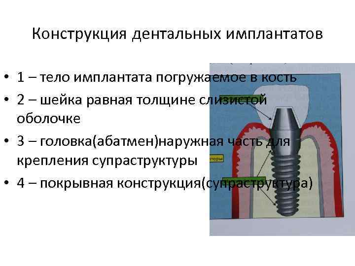 Конструкция дентальных имплантатов • 1 – тело имплантата погружаемое в кость • 2 –