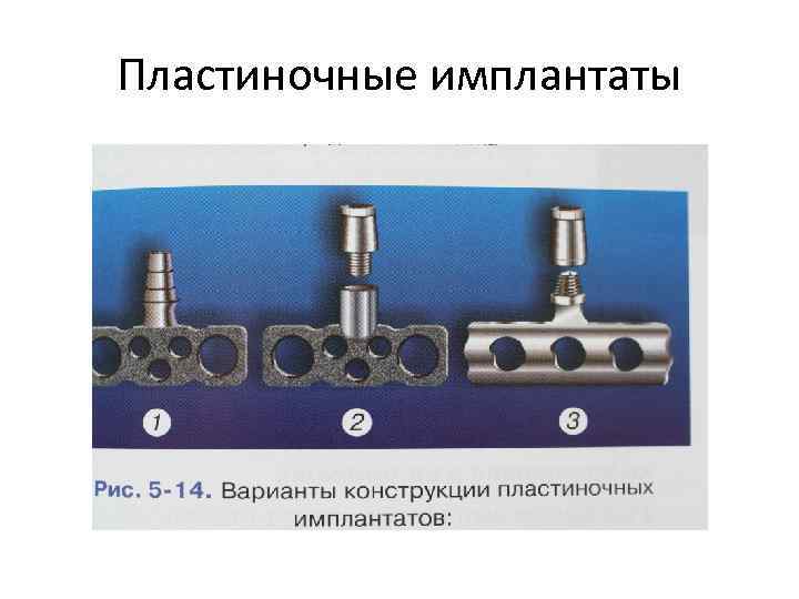 Пластиночные имплантаты 