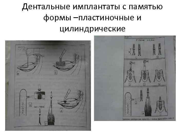 Дентальные имплантаты с памятью формы –пластиночные и цилиндрические 