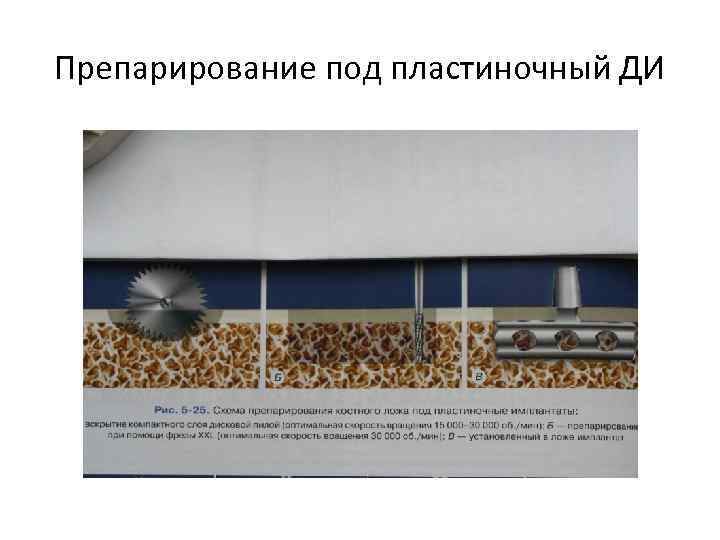 Препарирование под пластиночный ДИ 