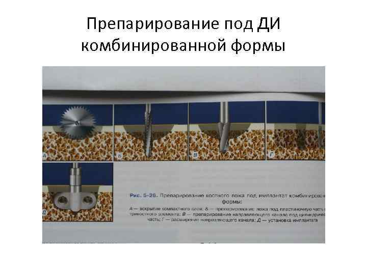 Препарирование под ДИ комбинированной формы 