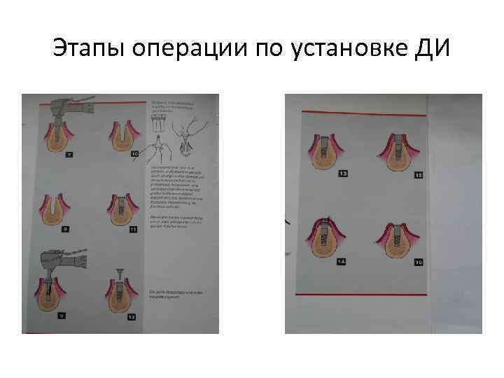 Этапы операции по установке ДИ 