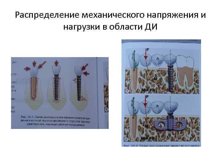 Распределение механического напряжения и нагрузки в области ДИ 