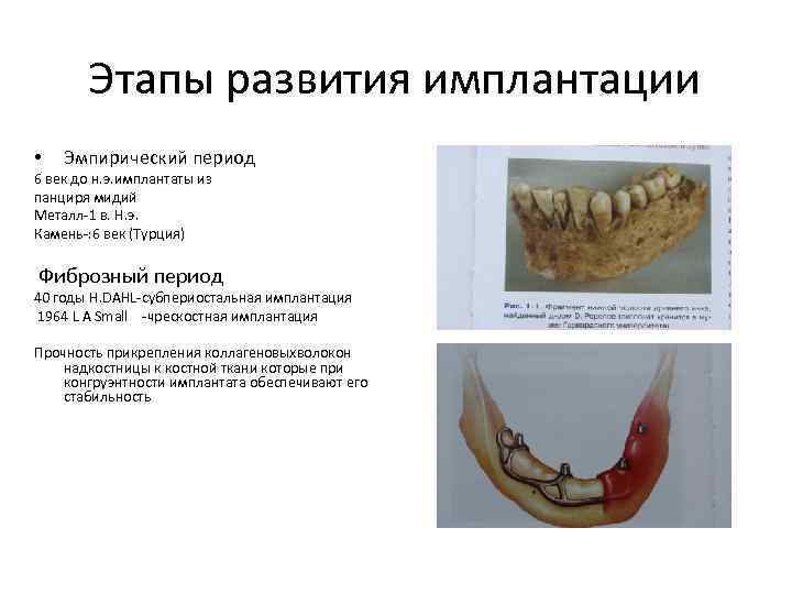 Этапы развития имплантации • Эмпирический период 6 век до н. э. имплантаты из панциря