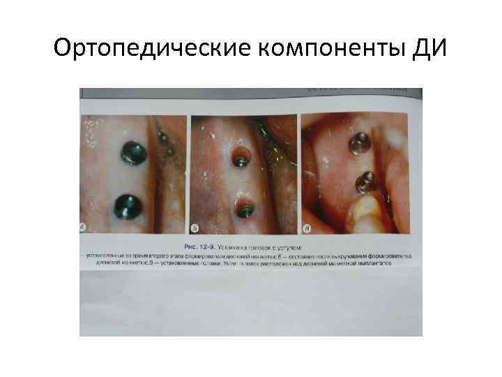 Ортопедические компоненты ДИ 