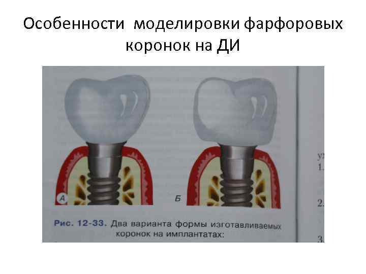 Особенности моделировки фарфоровых коронок на ДИ 