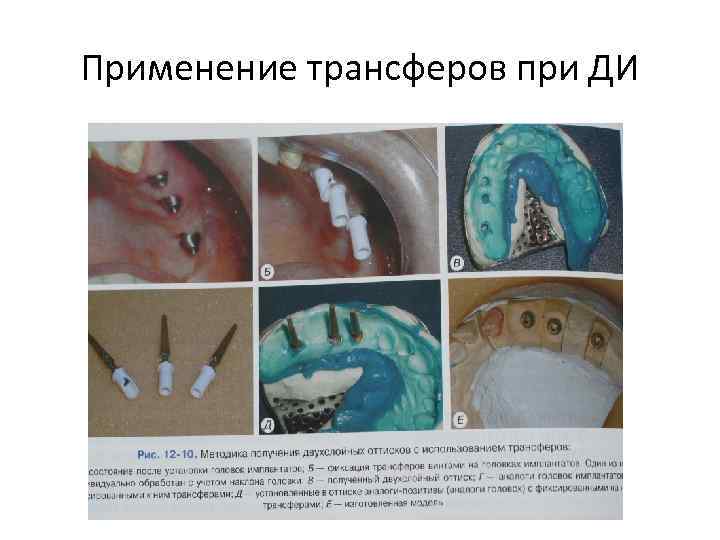 Применение трансферов при ДИ 
