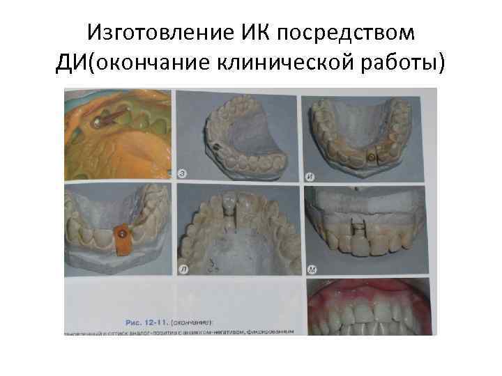 Изготовление ИК посредством ДИ(окончание клинической работы) 