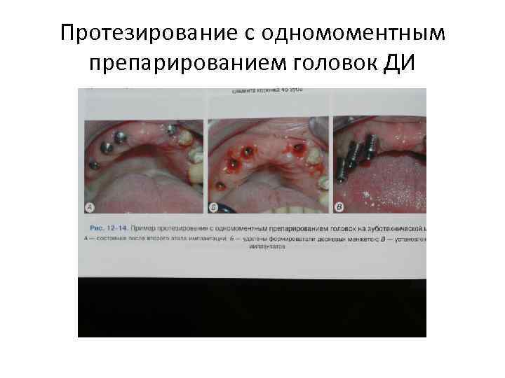 Протезирование с одномоментным препарированием головок ДИ 