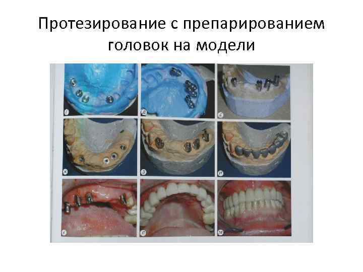 Протезирование с препарированием головок на модели 
