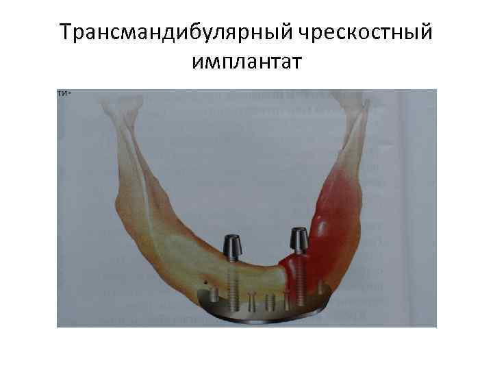 Трансмандибулярный чрескостный имплантат 