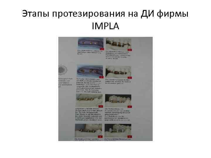 Этапы протезирования на ДИ фирмы IMPLA 