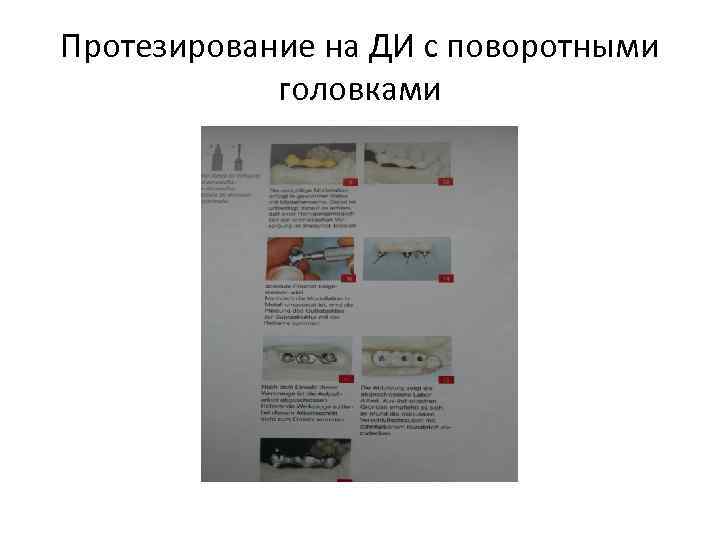 Протезирование на ДИ с поворотными головками 
