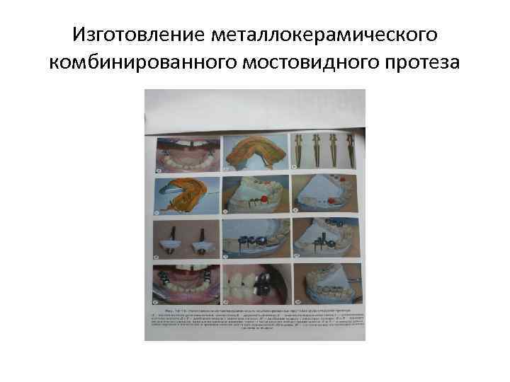 Изготовление металлокерамического комбинированного мостовидного протеза 