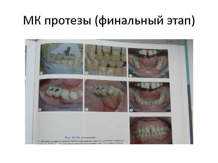 МК протезы (финальный этап) 