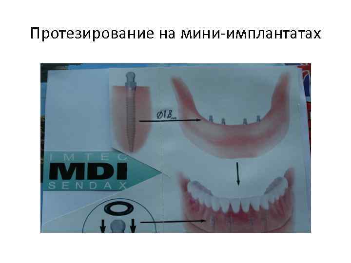 Протезирование на мини-имплантатах 