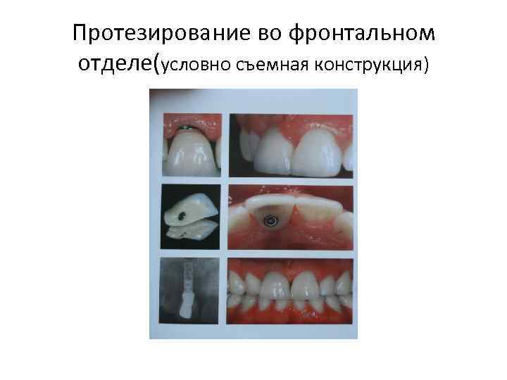 Протезирование во фронтальном отделе(условно съемная конструкция) 