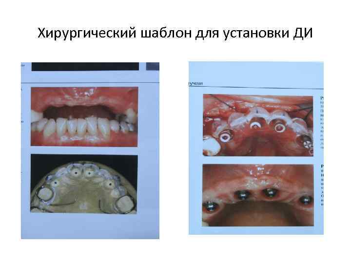 Хирургический шаблон для установки ДИ 