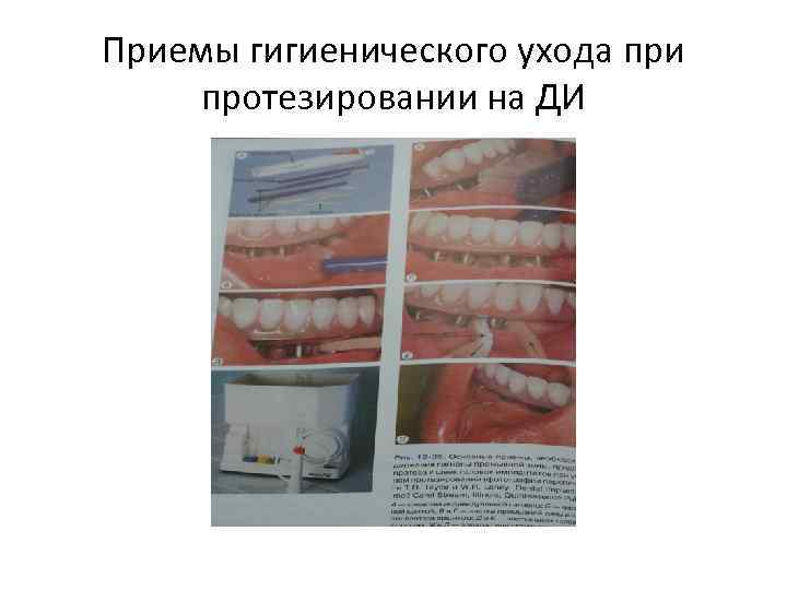 Приемы гигиенического ухода при протезировании на ДИ 