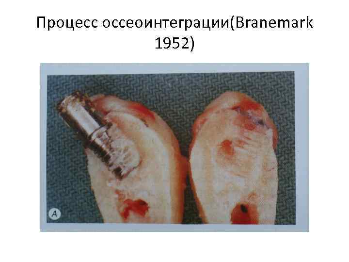 Процесс оссеоинтеграции(Branemark 1952) 