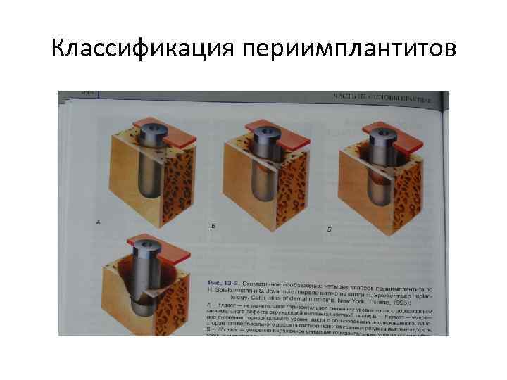Классификация периимплантитов 