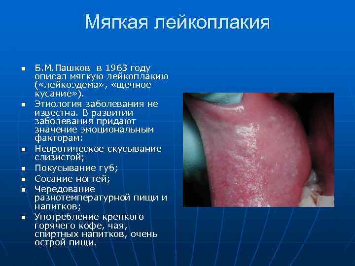 Мягкая лейкоплакия n n n n Б. М. Пашков в 1963 году описал мягкую