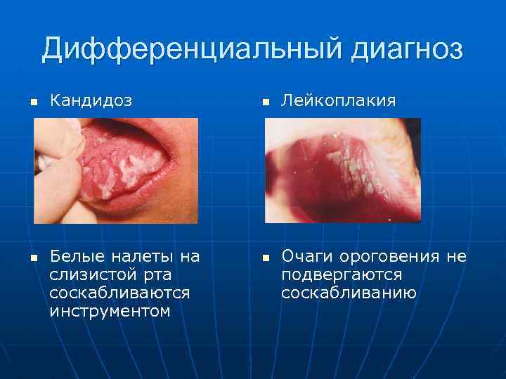 Дифференциальный диагноз n n Кандидоз Белые налеты на слизистой рта соскабливаются инструментом n n