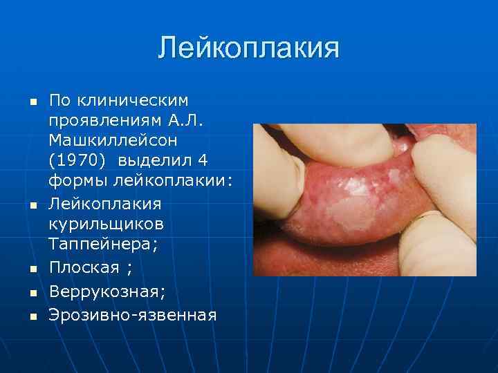 Лейкоплакия n n n По клиническим проявлениям А. Л. Машкиллейсон (1970) выделил 4 формы