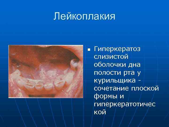 Лейкоплакия полости рта фото лечение