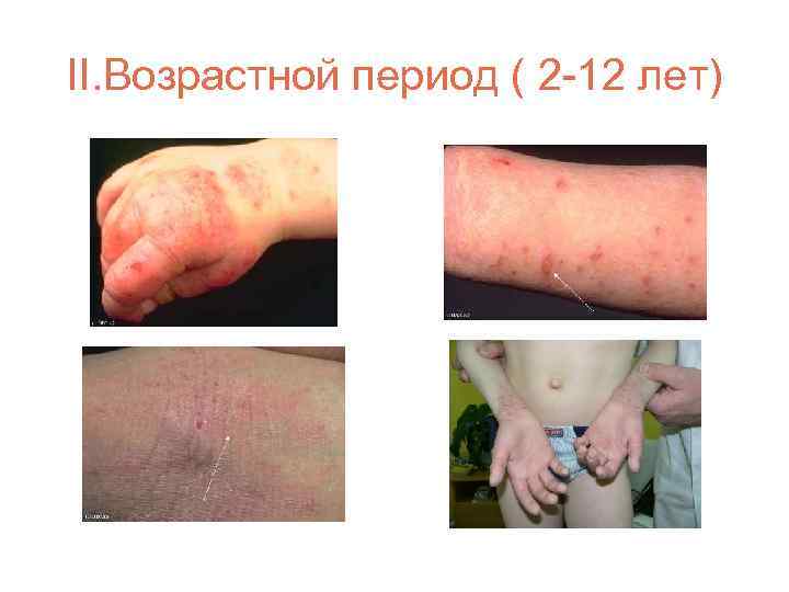 II. Возрастной период ( 2 -12 лет) 