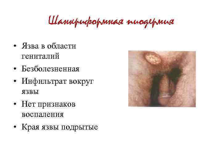 Шанкриформная пиодермия • Язва в области гениталий • Безболезненная • Инфильтрат вокруг язвы •